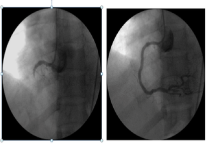 Can thiệp động mạch vành ở bệnh nhân nữ trẻ tuổi bị nhồi máu cơ tim