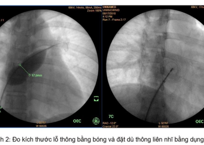 Điều trị bệnh tim bẩm sinh thông liên nhĩ bằng dù Amplatzer