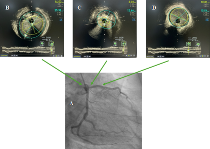 Ứng Dụng Kỹ Thuật Siêu Âm Trong Lòng Mạch (IVUS) Trong Can Thiệp Động Mạch Vành Qua Da