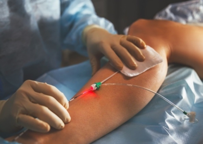 Triển Khai Điều Trị Suy Giãn Tĩnh Mạch Chi Dưới Bằng Laser Nội Mạch Tại Bệnh Viện Trường Đại Học Y Dược Huế