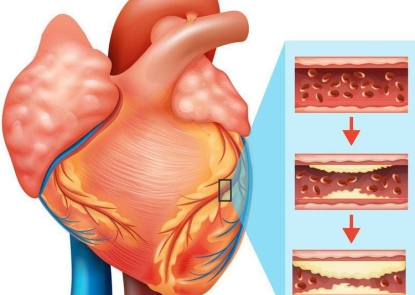 Cẩm nang phòng ngừa bệnh động mạch vành
